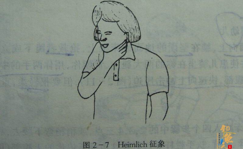 抢救异物卡喉窒息的Heimlich(海姆利希)手法